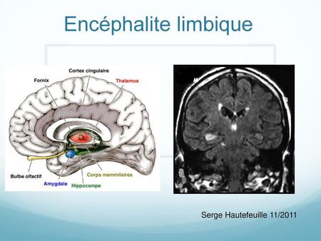 Encéphalite limbique Serge Hautefeuille 11/2011.