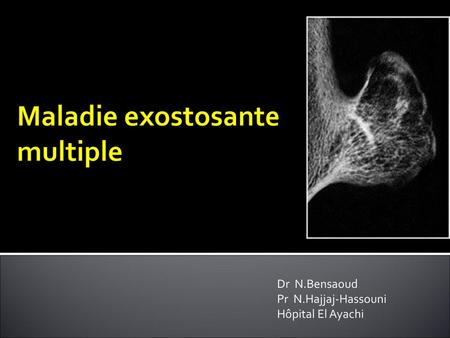 Maladie exostosante multiple