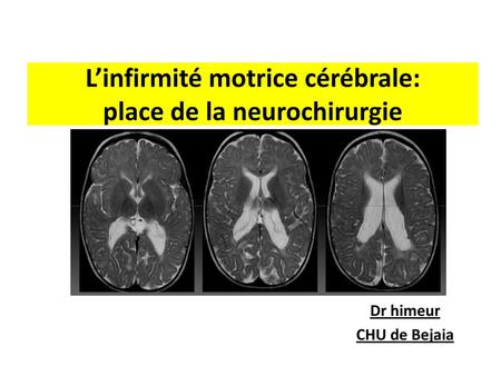 L’infirmité motrice cérébrale: place de la neurochirurgie