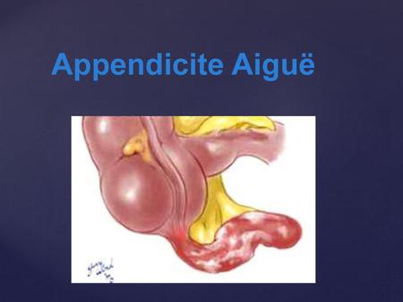Appendicite Aiguë.