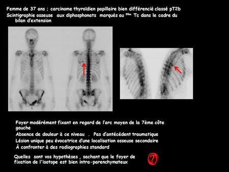 Femme de 37 ans ; carcinome thyroïdien papillaire bien différencié classé pT2b Scintigraphie osseuse aux diphosphonats marqués au 99m Tc dans le cadre.