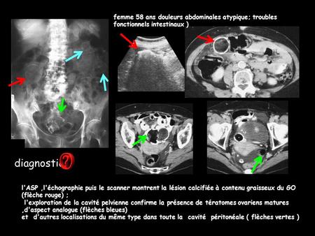 Femme 58 ans douleurs abdominales atypique; troubles fonctionnels intestinaux ) diagnostic l'ASP ,l'échographie puis le scanner montrent la lésion calcifiée.