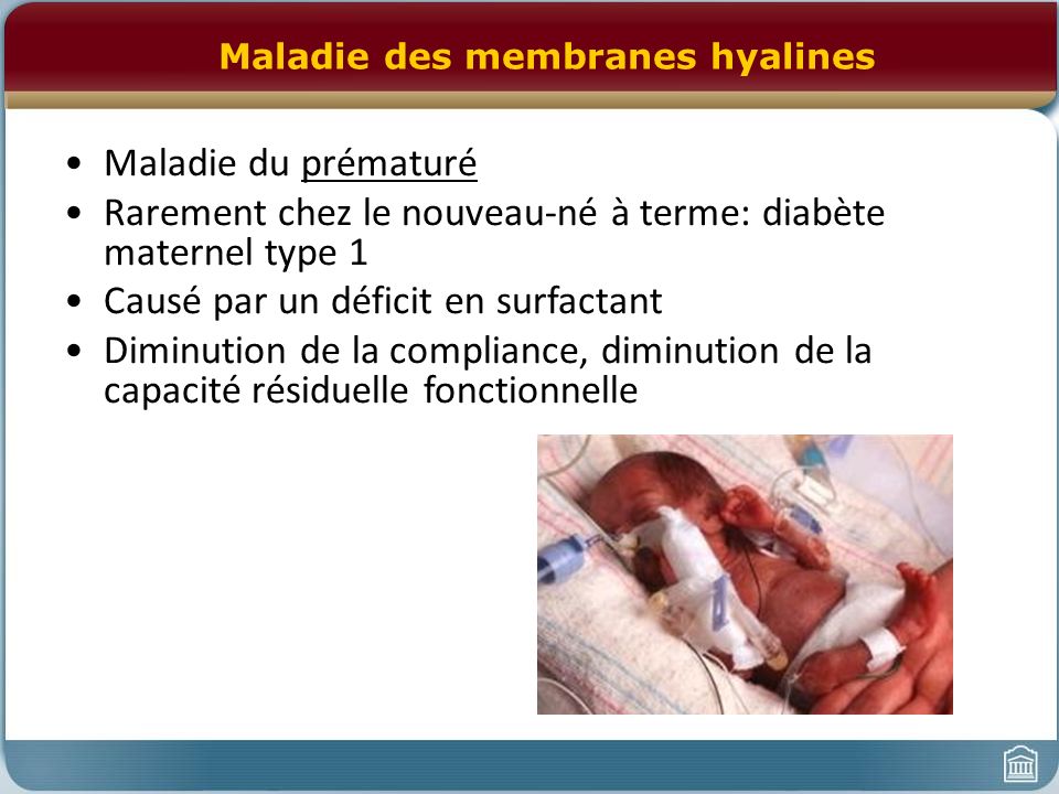 maladie des membranes Hyalines jessmariegab