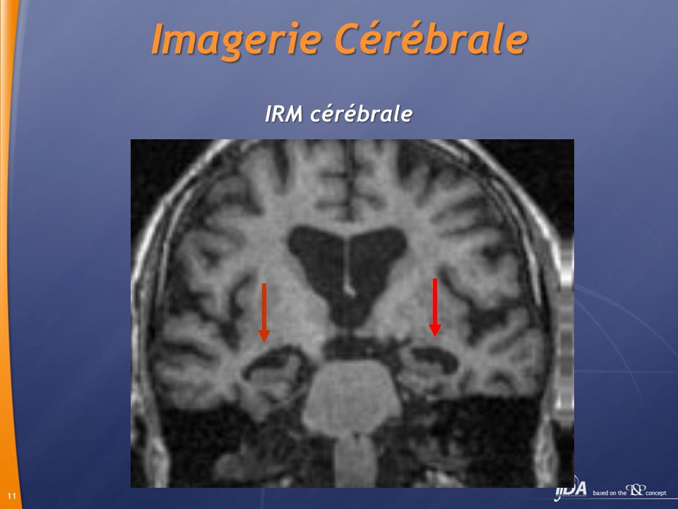 Imagerie Cérébrale IRM cérébrale
