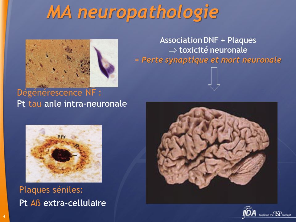 MA neuropathologie Dégénérescence NF : Pt tau anle intra-neuronale