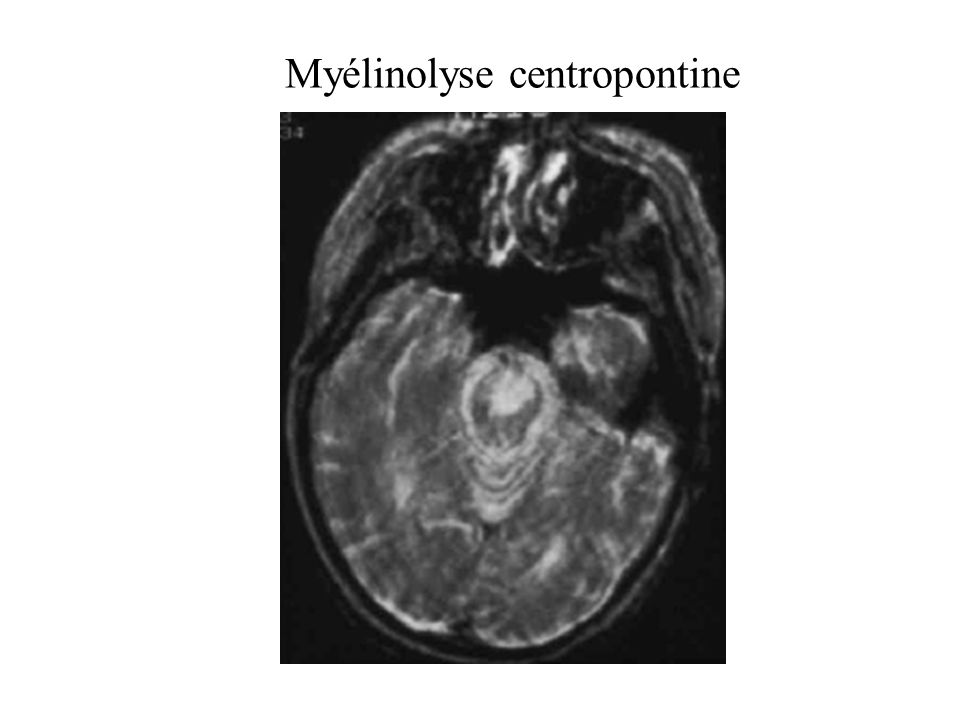 Myélinolyse centropontine