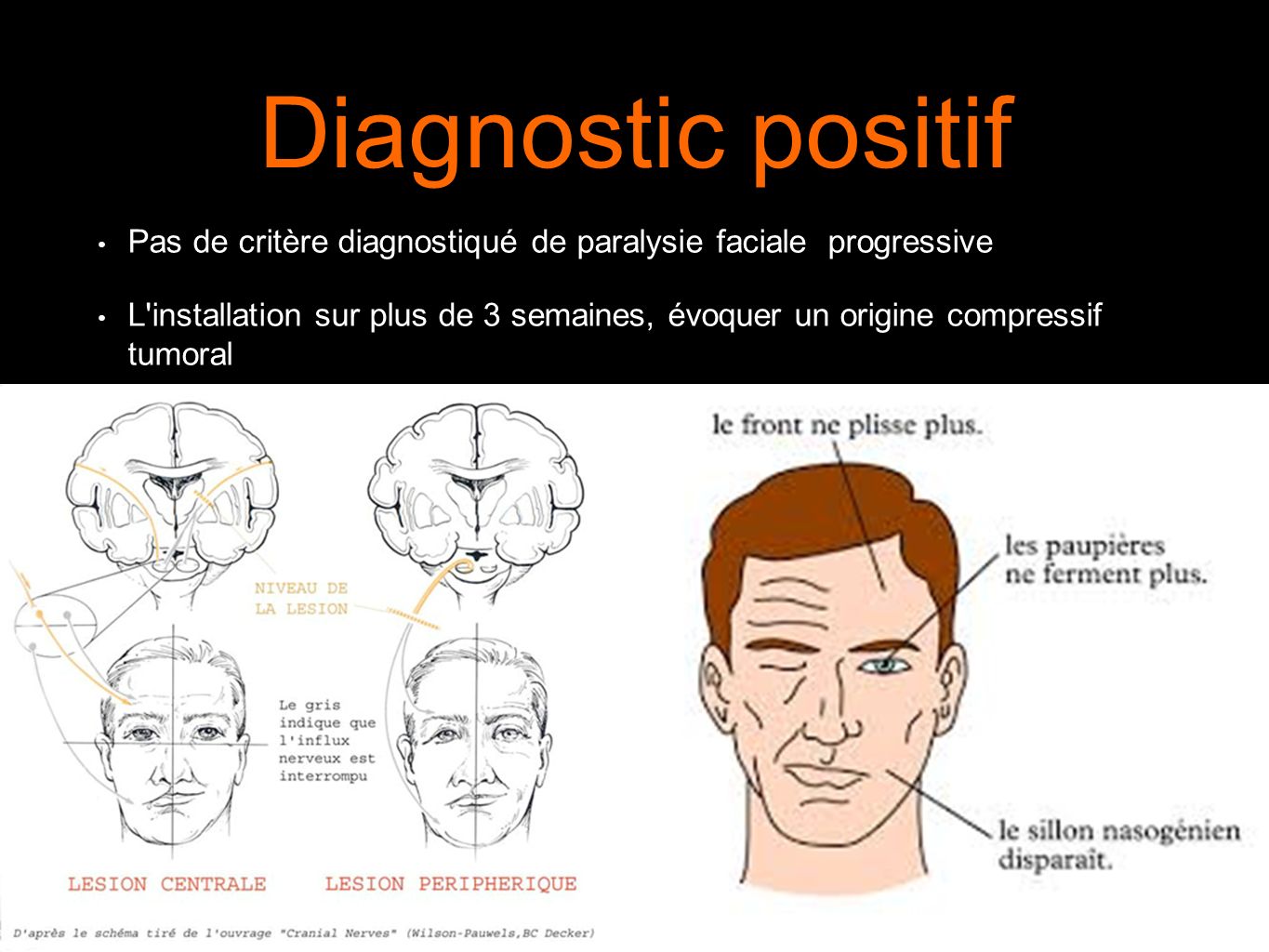 Orientation diagnostic devant une paralysie facial progressive ...