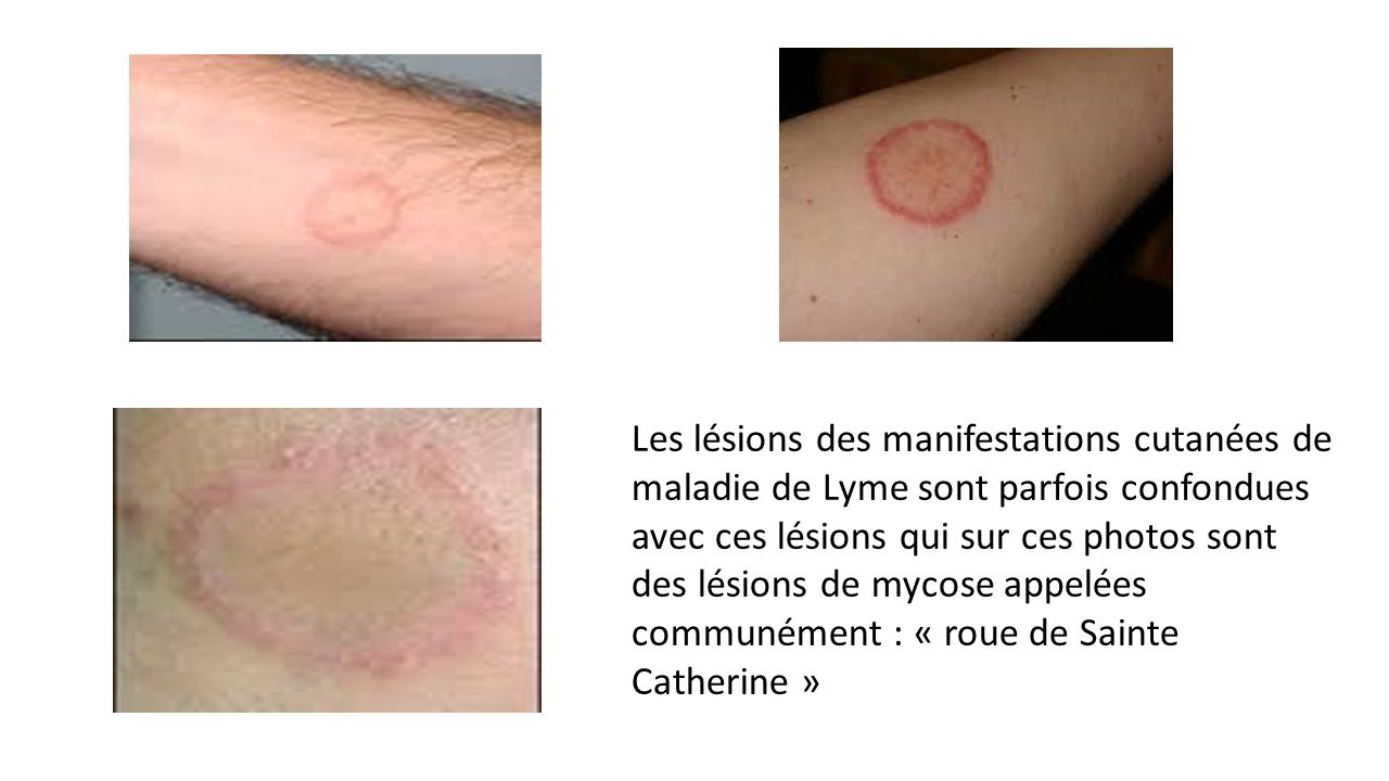 Les lésions des manifestations cutanées de maladie de Lyme sont parfois confondues avec ces lésions qui sur ces photos sont des lésions de mycose appelées communément : « roue de Sainte Catherine »