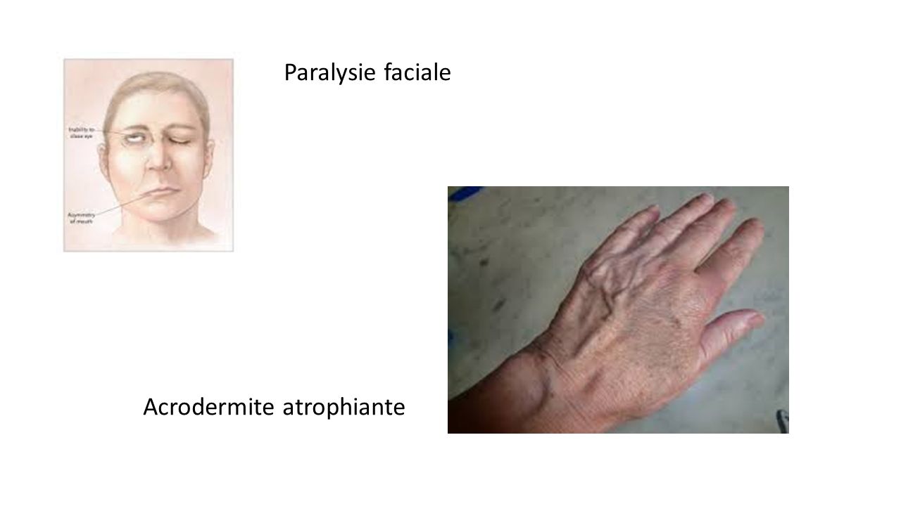 Paralysie faciale Acrodermite atrophiante