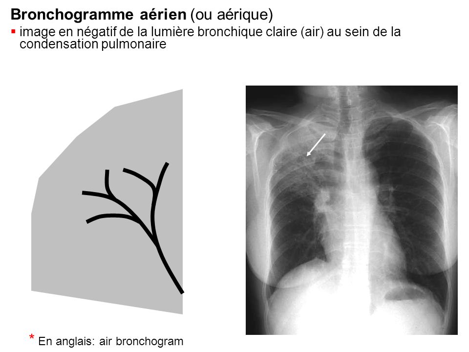 Bronchogramme aérien (ou aérique)