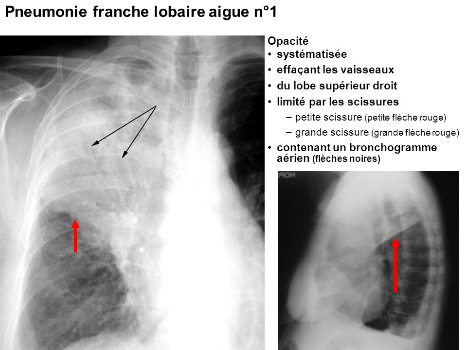 Pneumonie franche lobaire aigue n°1