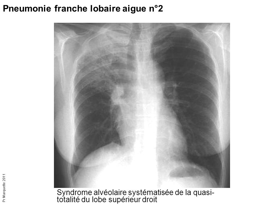 Pneumonie franche lobaire aigue n°2