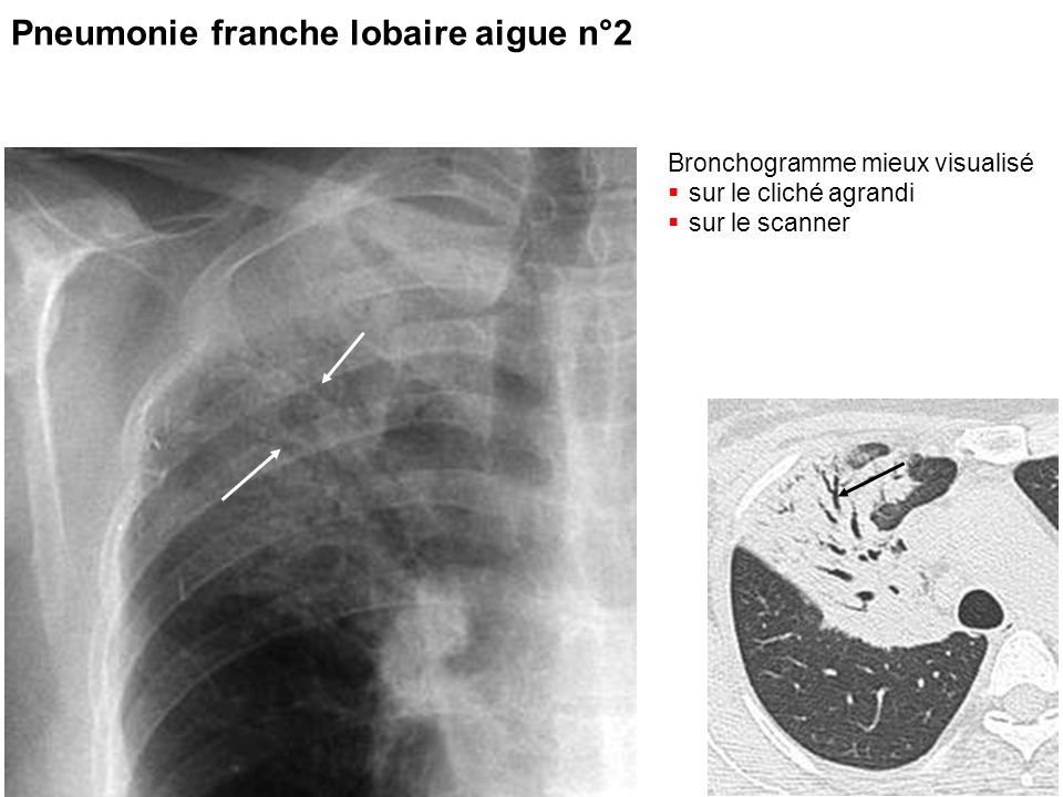 Pneumonie franche lobaire aigue n°2