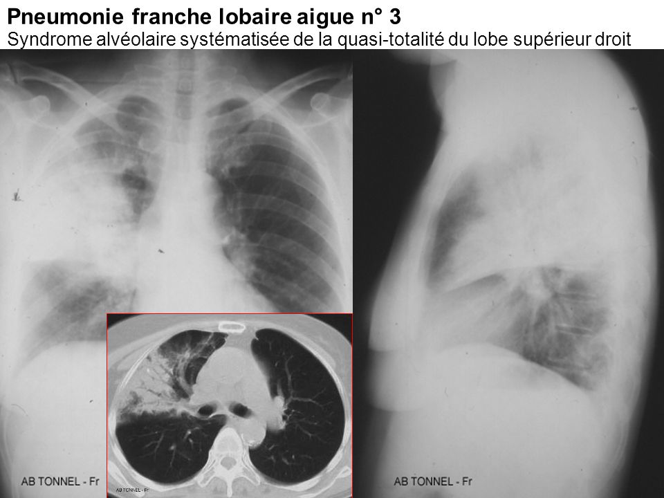 Pneumonie franche lobaire aigue n° 3