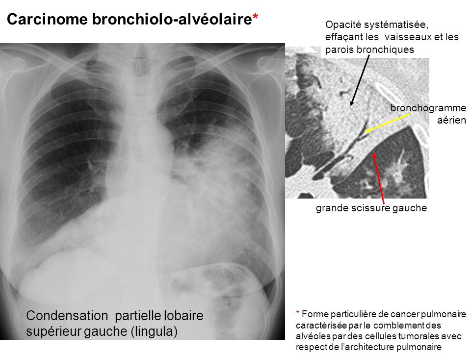 Carcinome bronchiolo-alvéolaire*