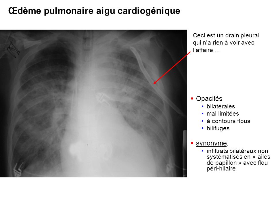 Œdème pulmonaire aigu cardiogénique