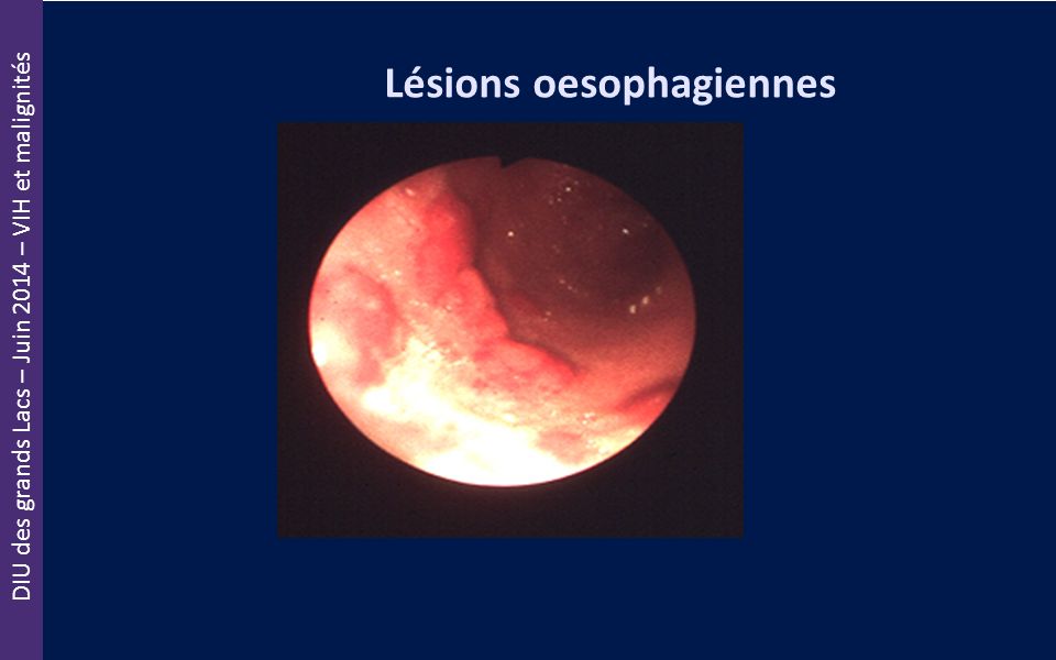 Lésions oesophagiennes
