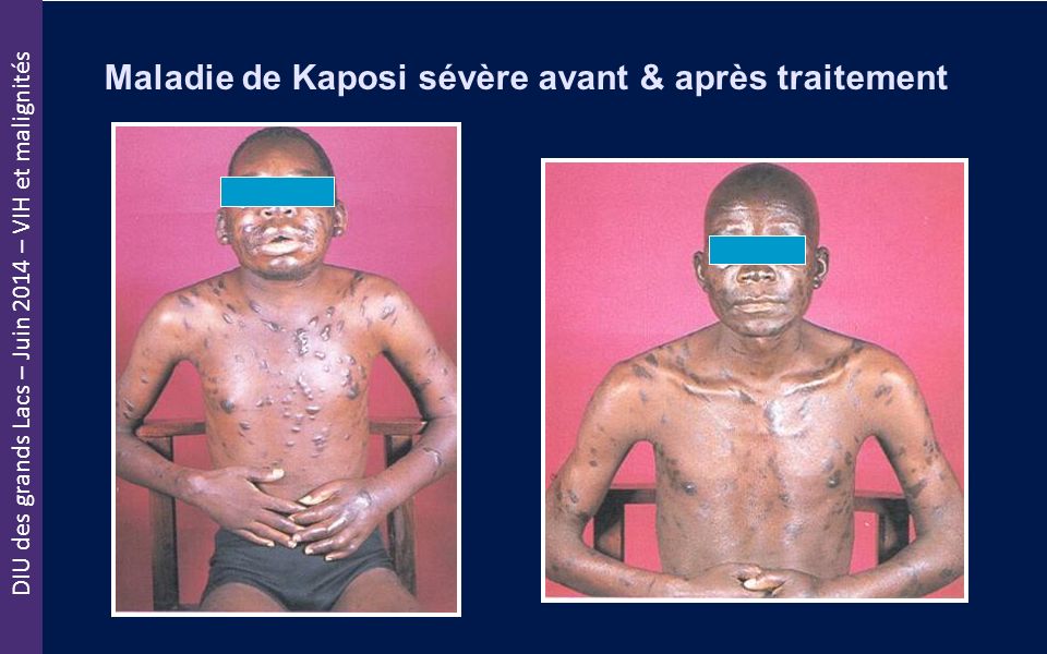 Maladie de Kaposi sévère avant & après traitement