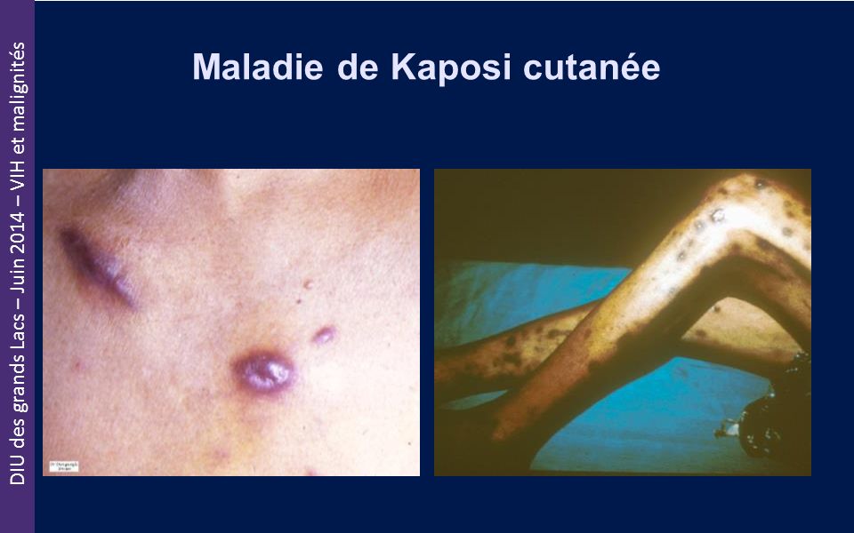 Maladie de Kaposi cutanée