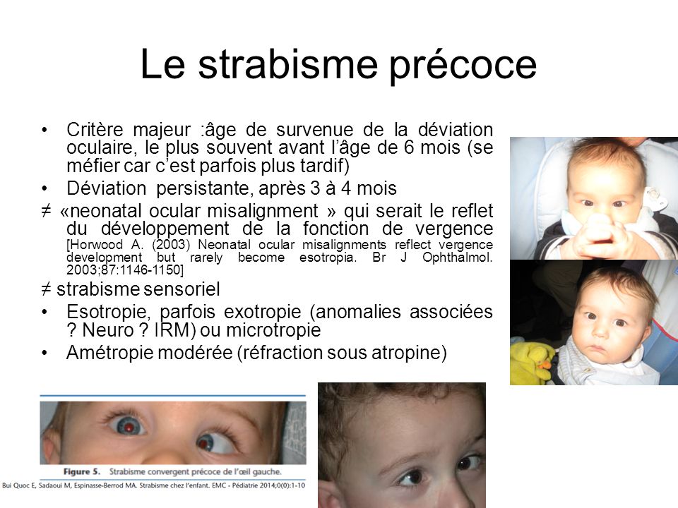 Module 13 Diplopie Et Strabisme Chez L Enfant Ppt Video Online Telecharger