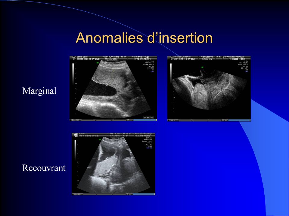 Anomalies d’insertion