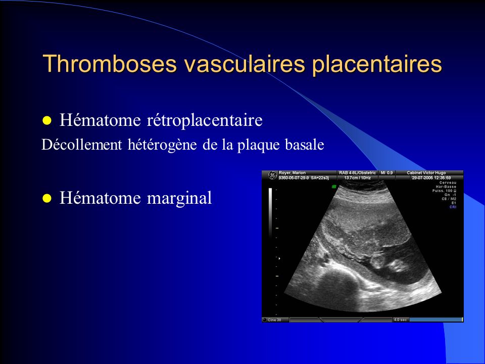 Thromboses vasculaires placentaires