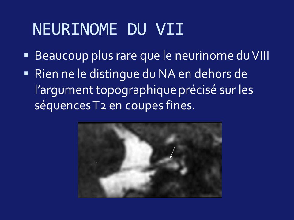 NEURINOME DU VII Beaucoup plus rare que le neurinome du VIII
