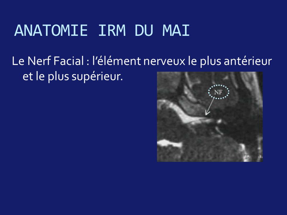ANATOMIE IRM DU MAI Le Nerf Facial : l’élément nerveux le plus antérieur et le plus supérieur.