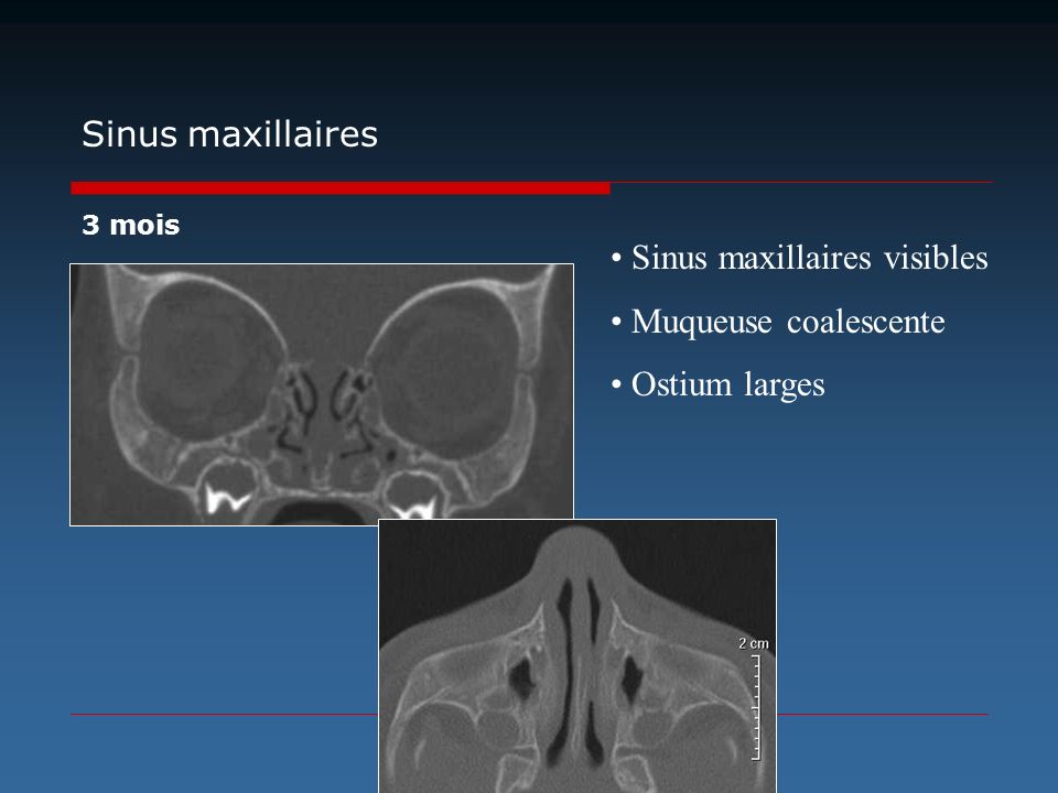 Sinus maxillaires visibles Muqueuse coalescente Ostium larges