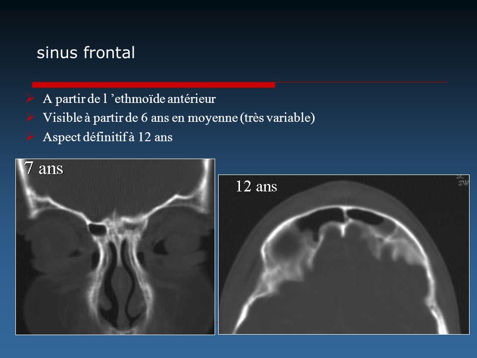 sinus frontal A partir de l ’ethmoïde antérieur