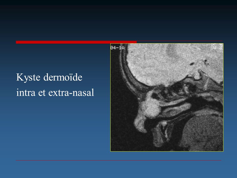 Kyste dermoïde intra et extra-nasal