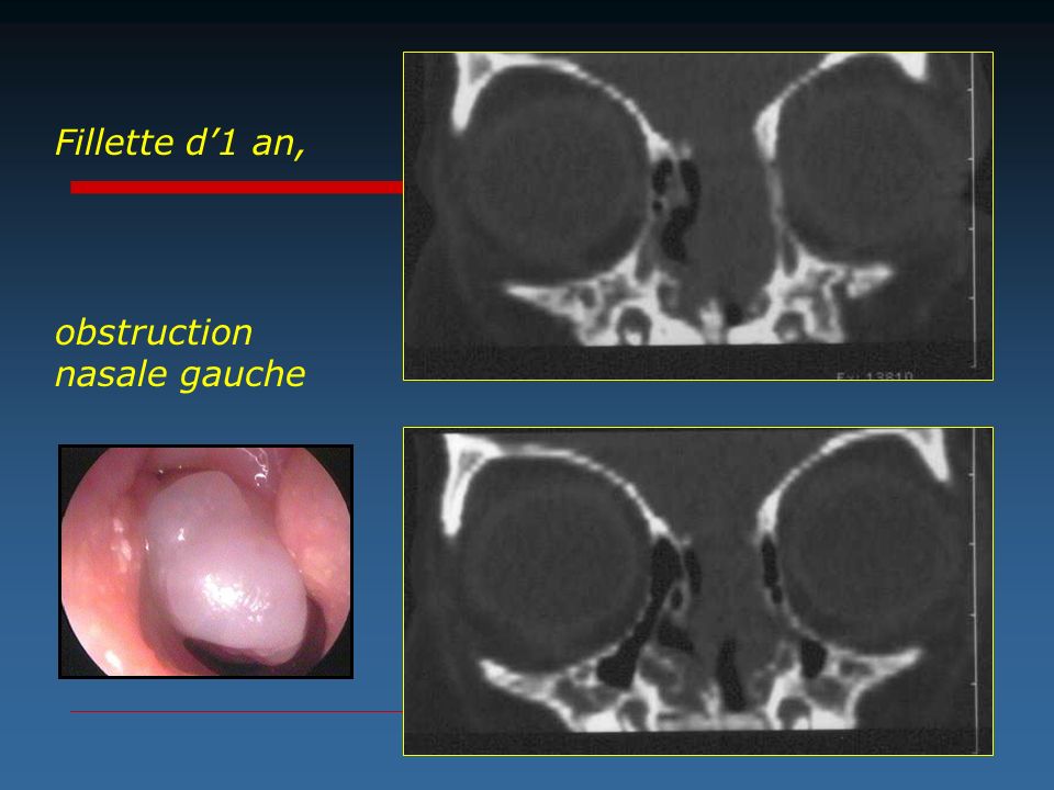 Fillette d’1 an, obstruction nasale gauche