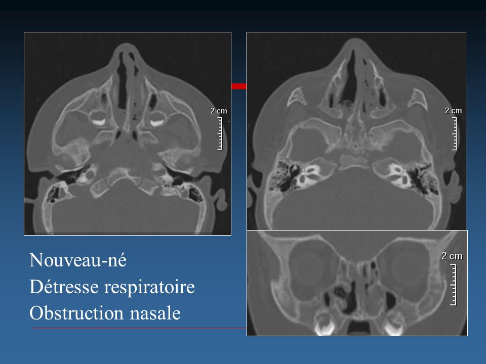 Nouveau-né Détresse respiratoire Obstruction nasale