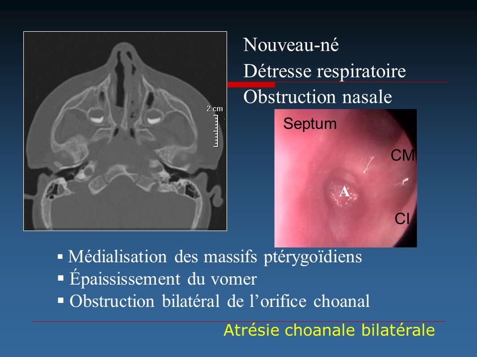 Détresse respiratoire Obstruction nasale