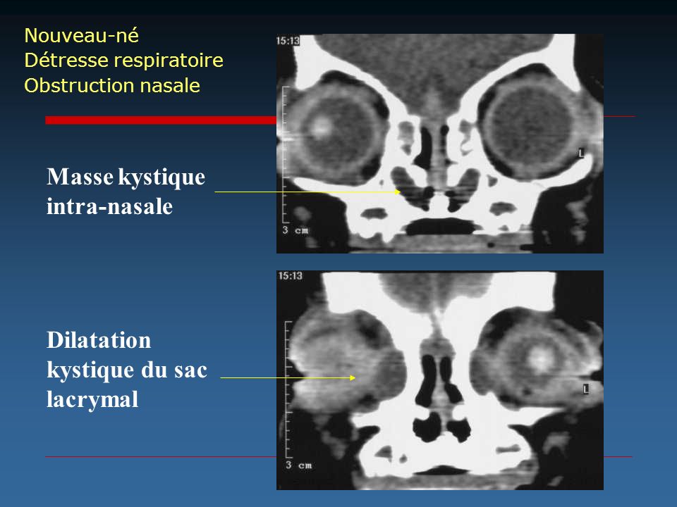 Masse kystique intra-nasale