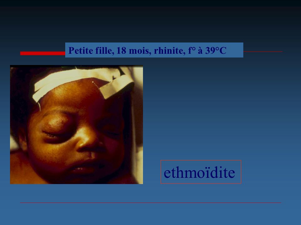 Petite fille, 18 mois, rhinite, f° à 39°C