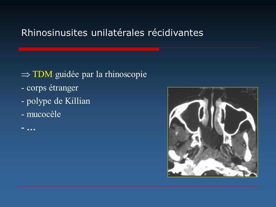 Rhinosinusites unilatérales récidivantes