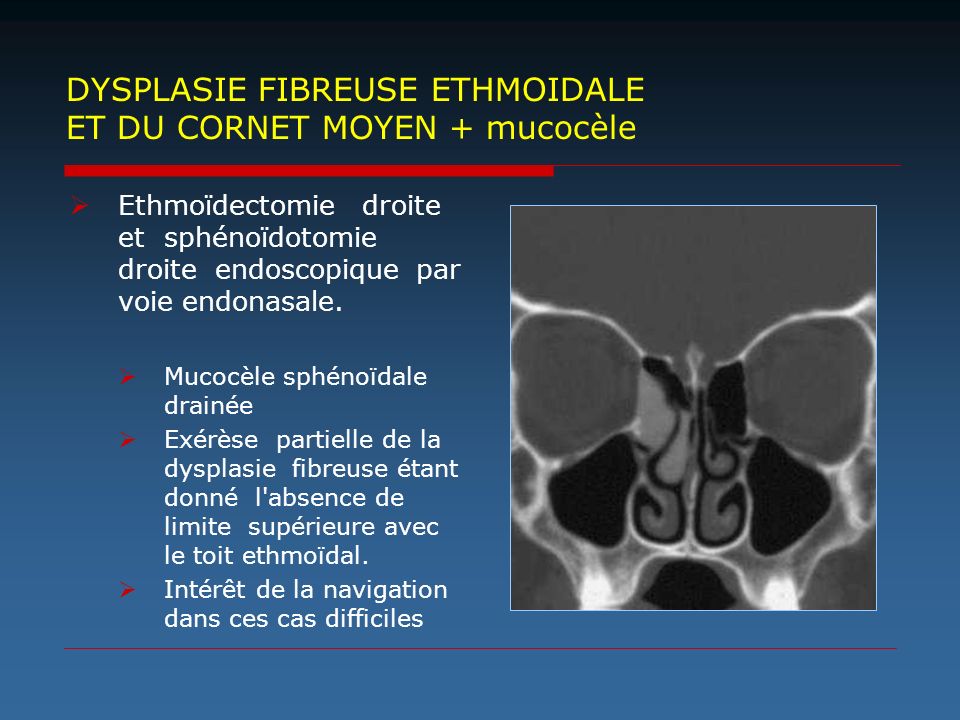 DYSPLASIE FIBREUSE ETHMOIDALE ET DU CORNET MOYEN + mucocèle