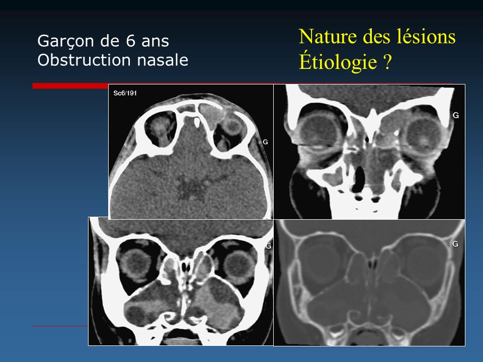 Nature des lésions Étiologie Garçon de 6 ans Obstruction nasale