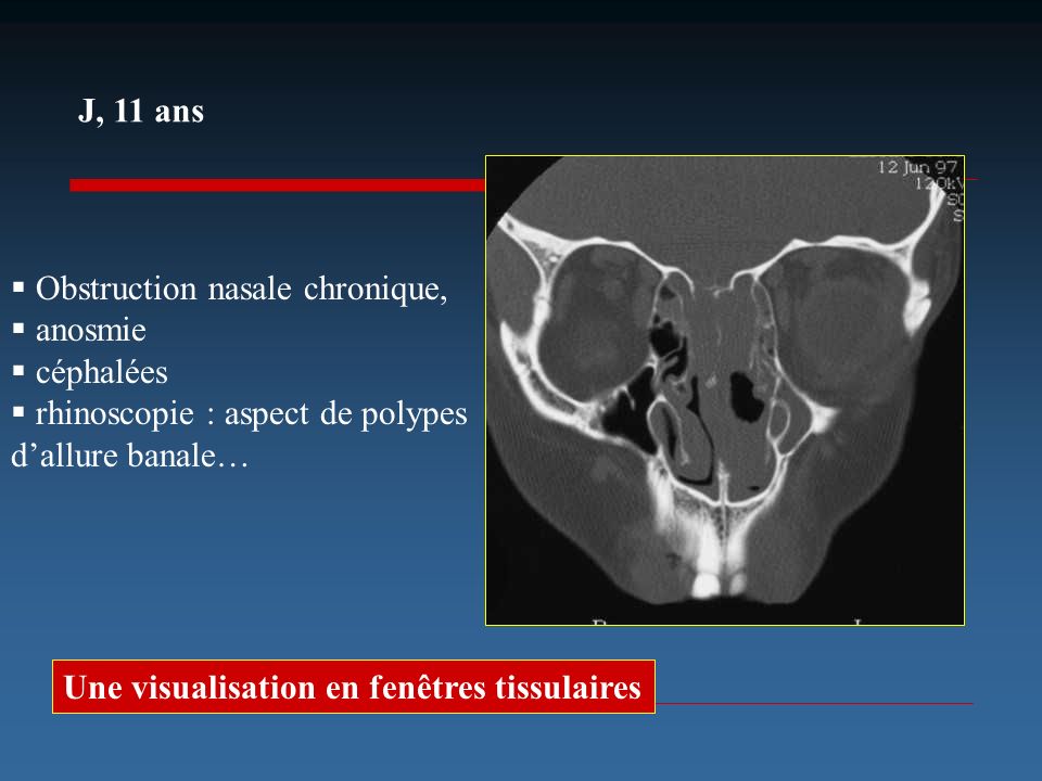 J, 11 ans Obstruction nasale chronique, anosmie. céphalées. rhinoscopie : aspect de polypes d’allure banale…
