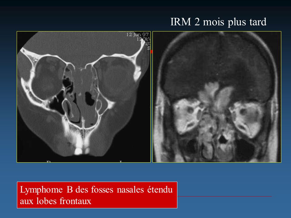 IRM 2 mois plus tard Lymphome B des fosses nasales étendu