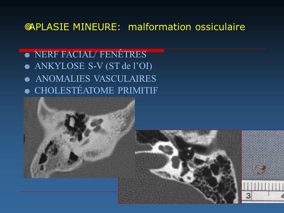 APLASIE MINEURE: malformation ossiculaire