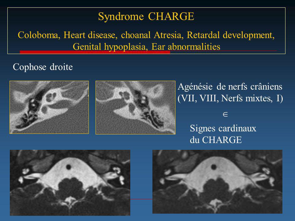 Syndrome CHARGE Coloboma, Heart disease, choanal Atresia, Retardal development, Genital hypoplasia, Ear abnormalities.