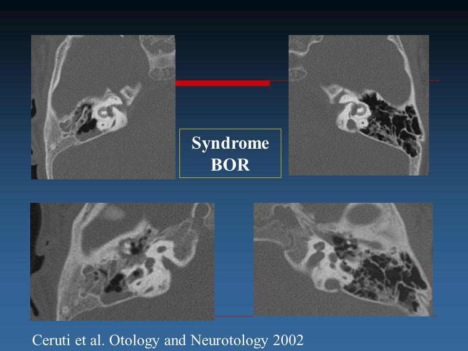 Syndrome BOR Ceruti et al. Otology and Neurotology 2002