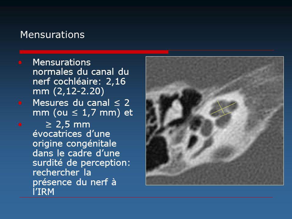 Mensurations Mensurations normales du canal du nerf cochléaire: 2,16 mm (2, ) Mesures du canal ≤ 2 mm (ou ≤ 1,7 mm) et.
