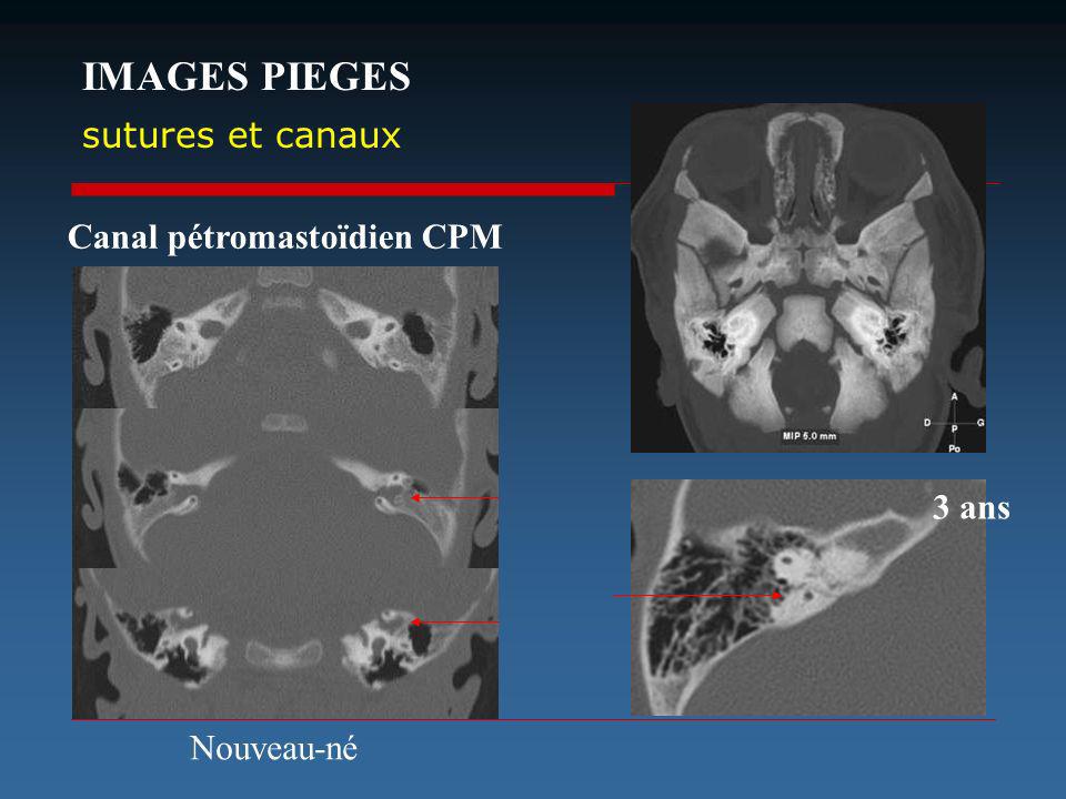 IMAGES PIEGES sutures et canaux Canal pétromastoïdien CPM 3 ans