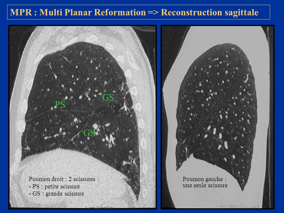 MPR : Multi Planar Reformation => Reconstruction sagittale