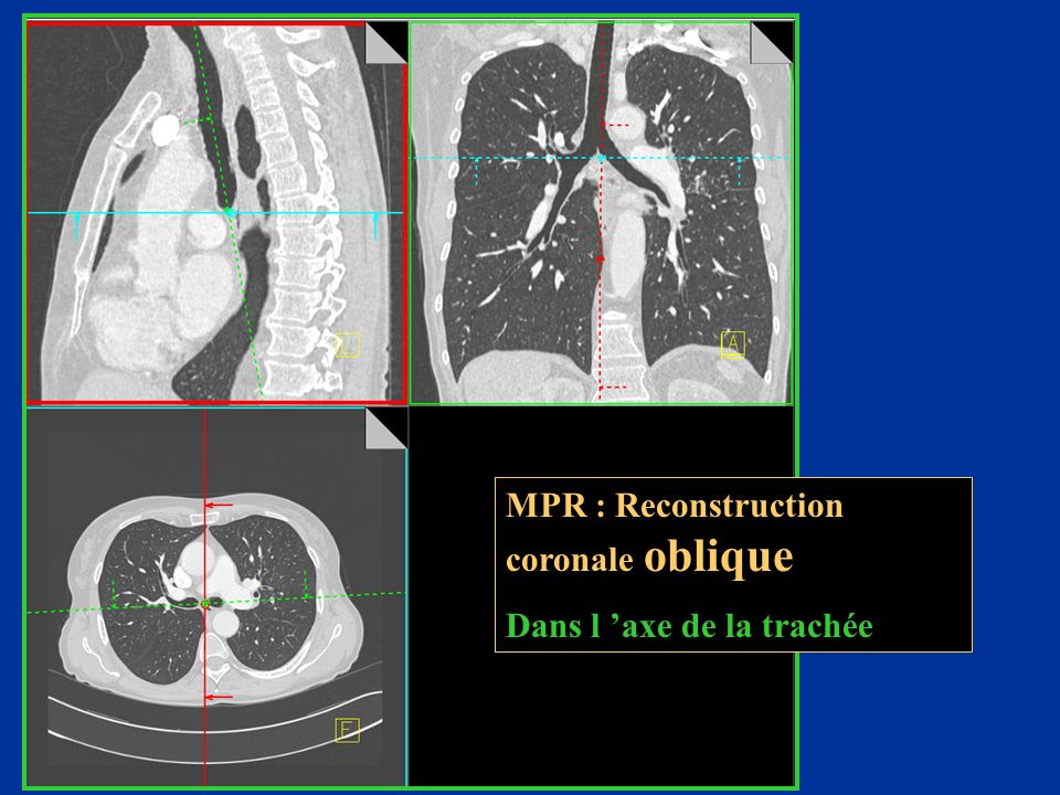 MPR : Reconstruction coronale oblique Dans l ’axe de la trachée