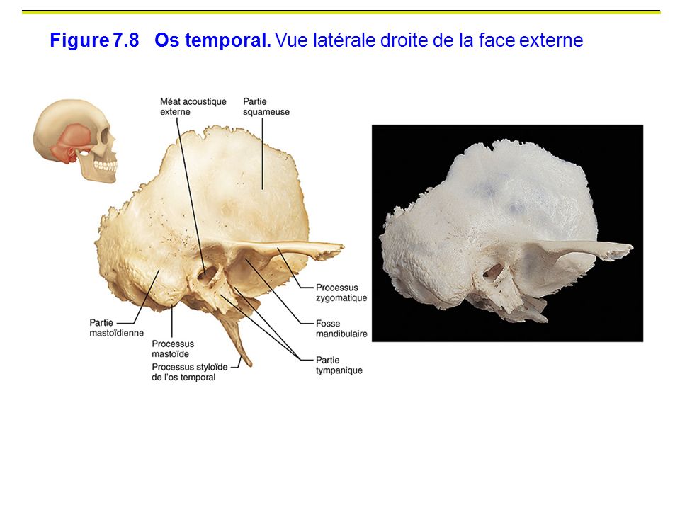 Figure 7.8 Os temporal. Vue latérale droite de la face externe