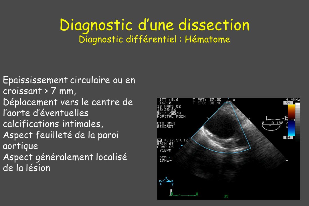 Diagnostic d’une dissection Diagnostic différentiel : Hématome